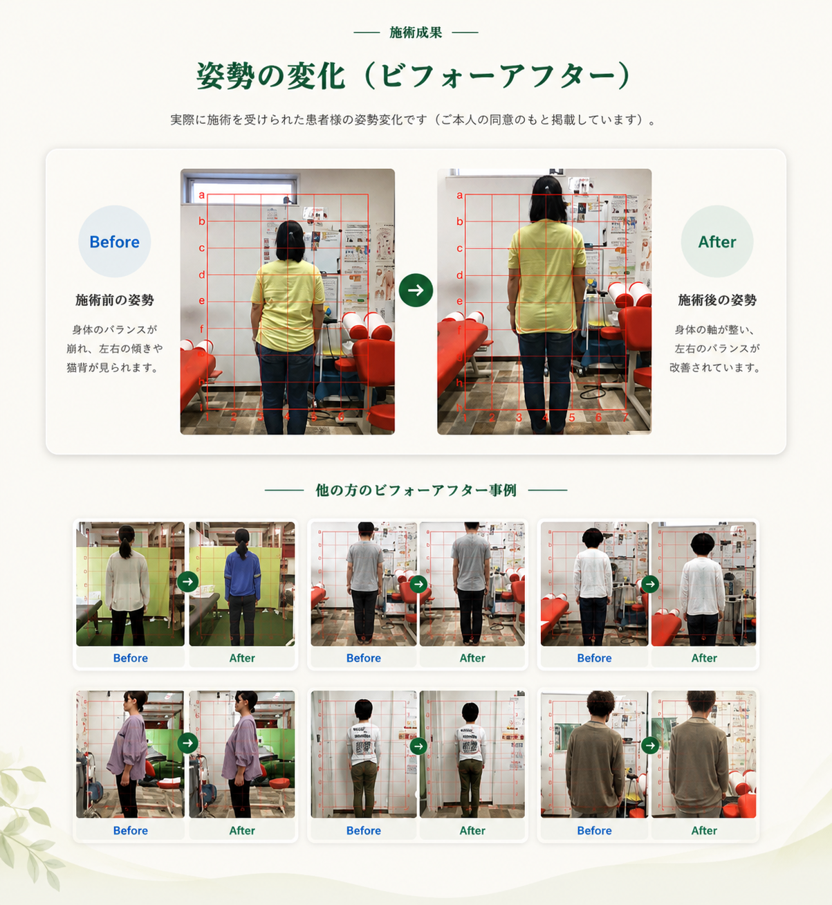 施術成果 ―姿勢の変化(ビフォーアフター)。実際に施術を受けられた患者様の姿勢変化です(ご本人の同意のもと掲載しています)。姿勢の変化には個人差がありますが、継続的な施術とセルフケアの組み合わせで、より良い変化が期待できます。お一人おひとりのお身体の状態に合わせてサポートいたします。