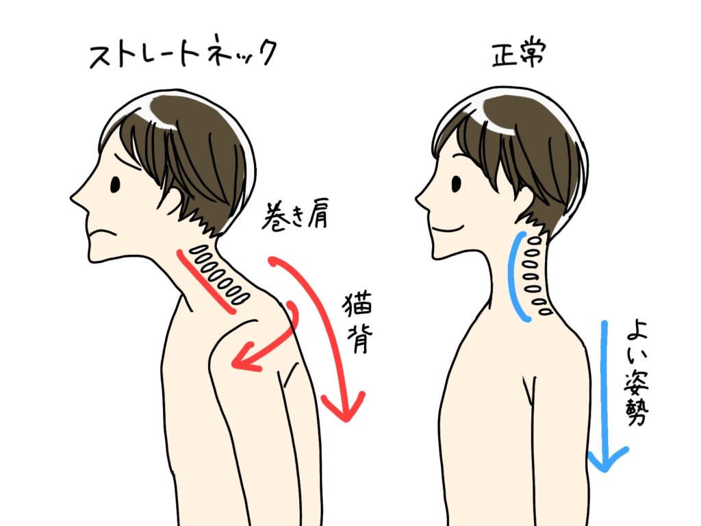 浜松頚椎症治療
