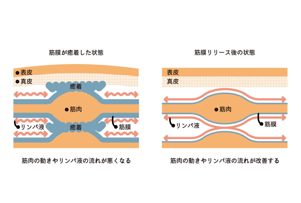 浜松筋膜リリース