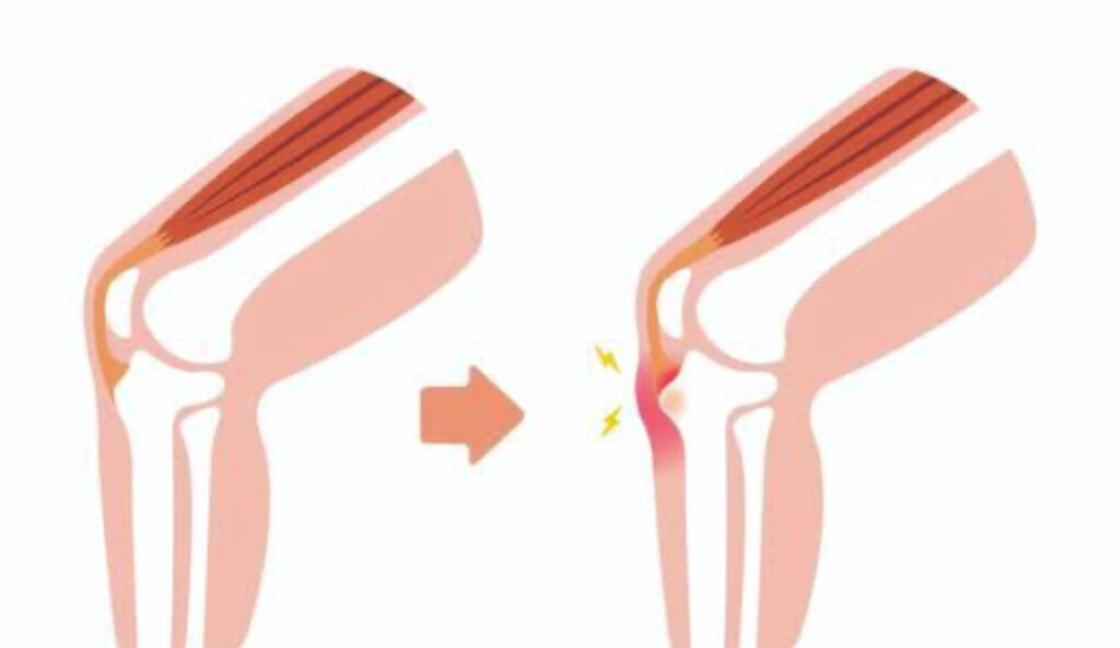 浜松オスグッド