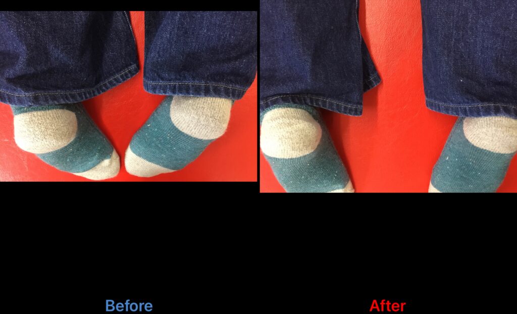 浜松整体下肢長差