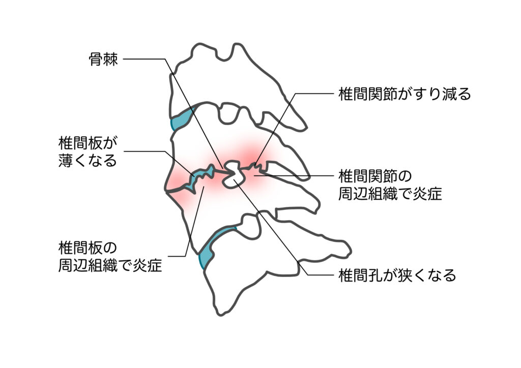 浜松整体頚椎症