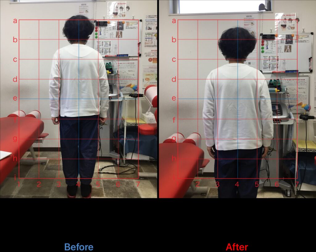 浜松姿勢改善前後比較症例