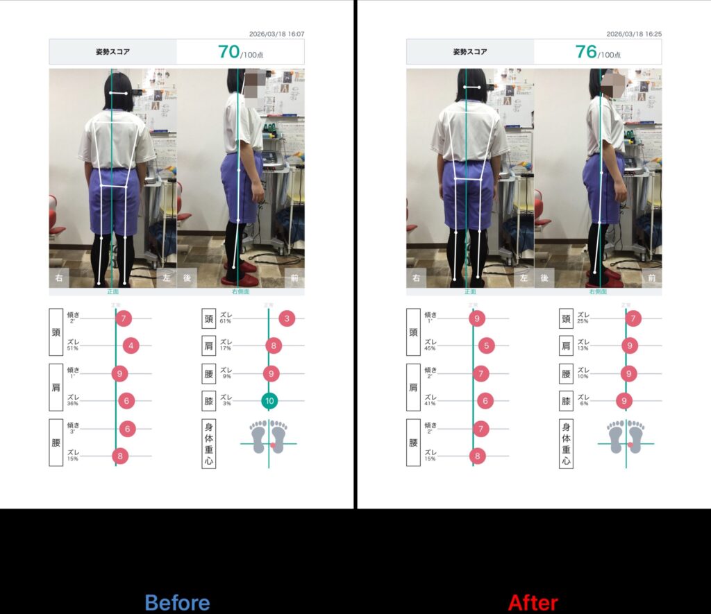 浜松反り腰改善